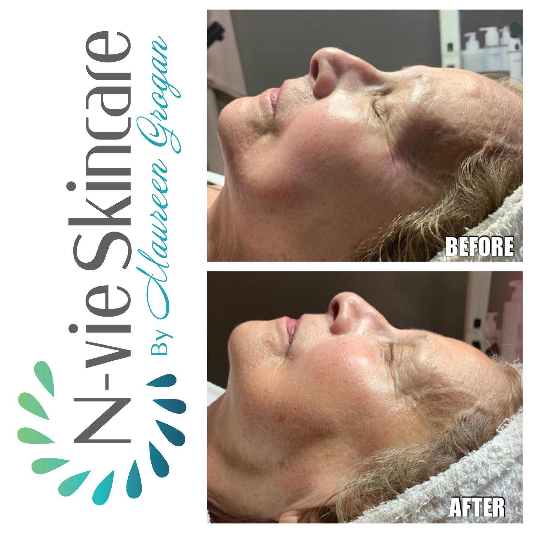 DermalInfusion-Facial.jpg