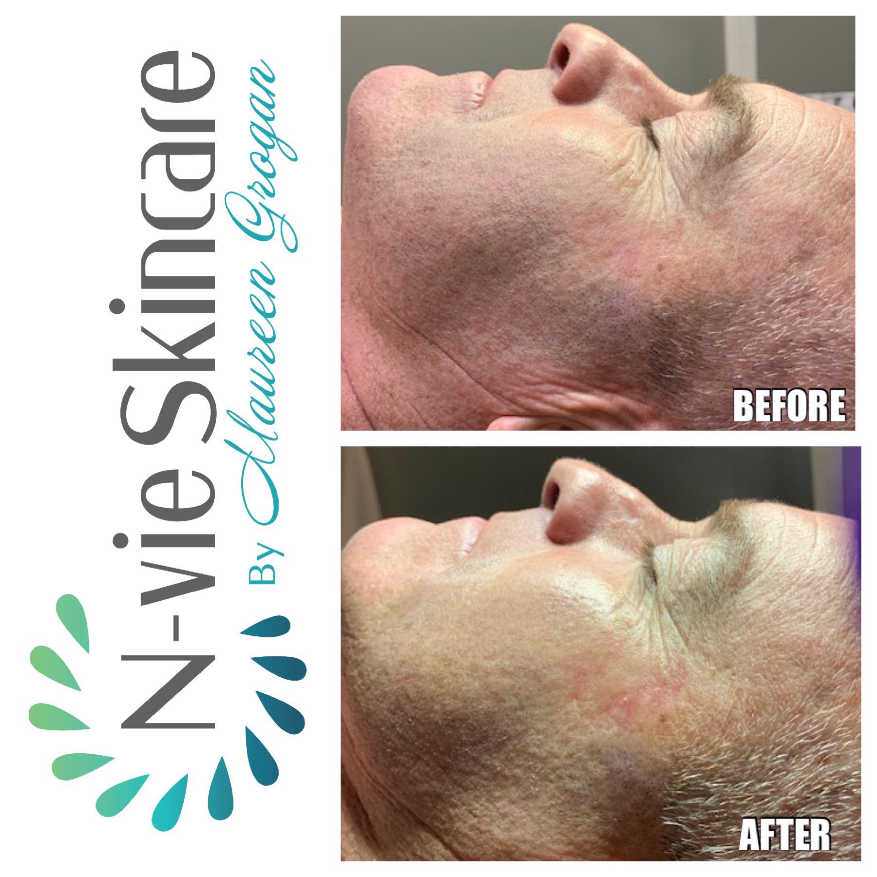 Diamond-Glow-DermalInfusion-Nvie-Skincare.jpg
