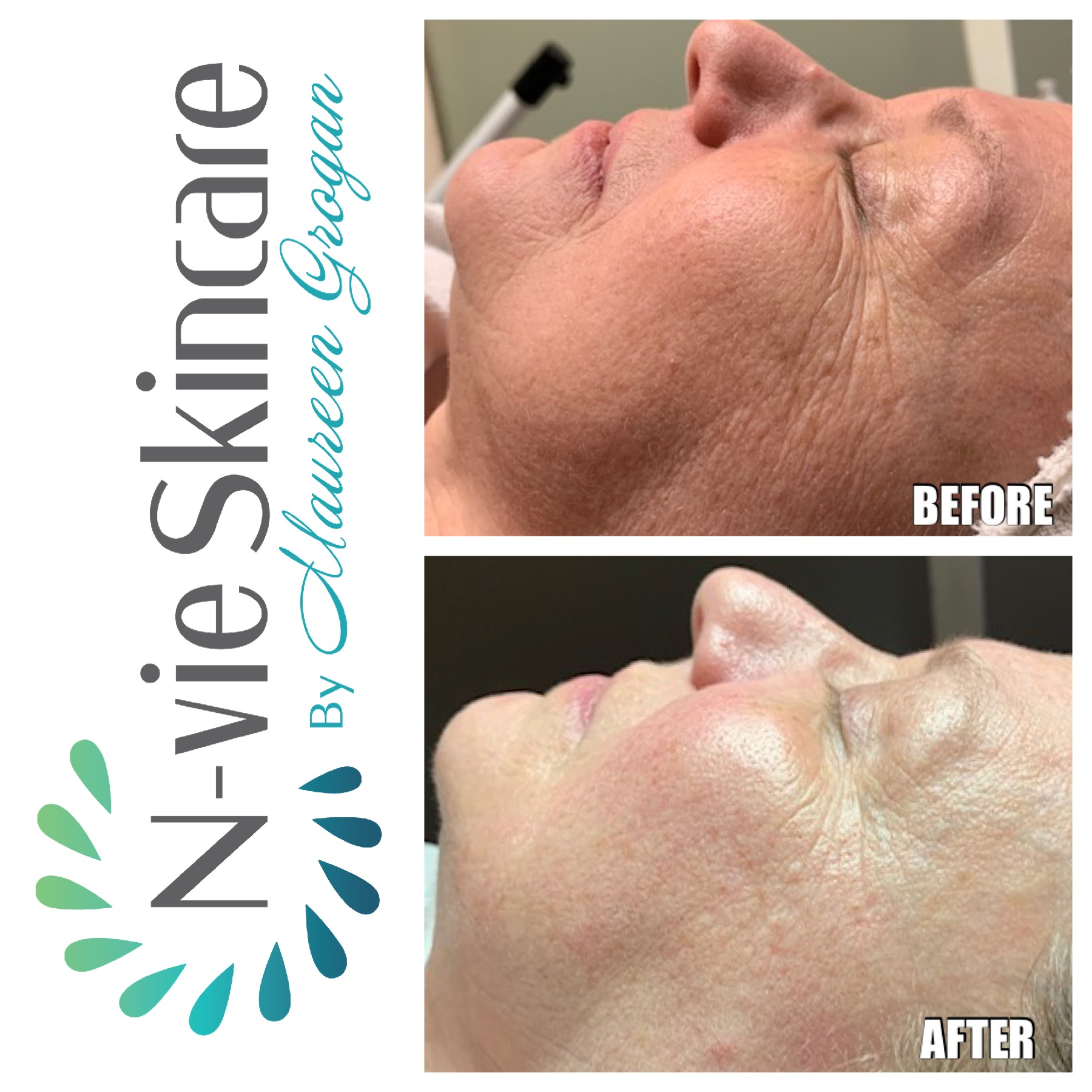 Diamond-Glow-Facial-At-Nvie-Skincare-In-Billerica-MA.jpg